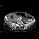 Tumour of cecum: CT - Computed tomography